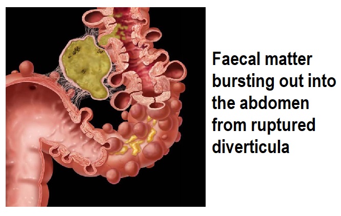 Colonoscopia diverticulos